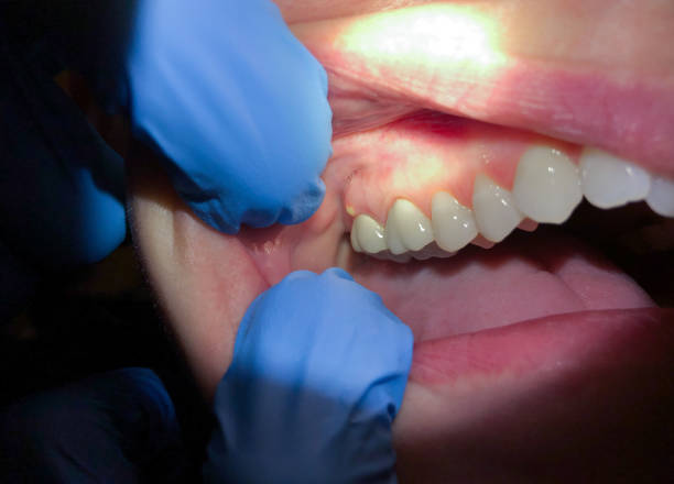 Best Emergency Care for Gum Disease in Oronoque, CT