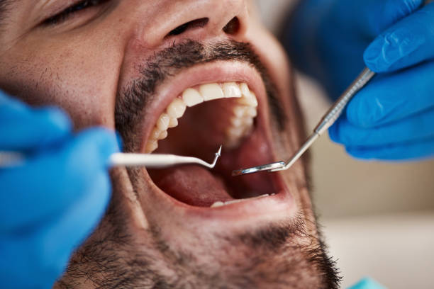 Best Dental Abscess Treatment in Oronoque, CT
